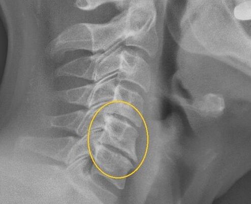 Osteochondrosis of cervical spine on an x ​​—Ray