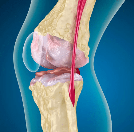 Arthrososis in the knee joint