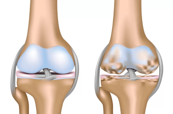 Deforming arthrosis of the knee joint