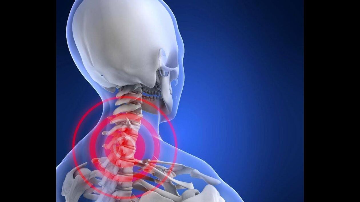 Osteochondrosis of the cervical spine